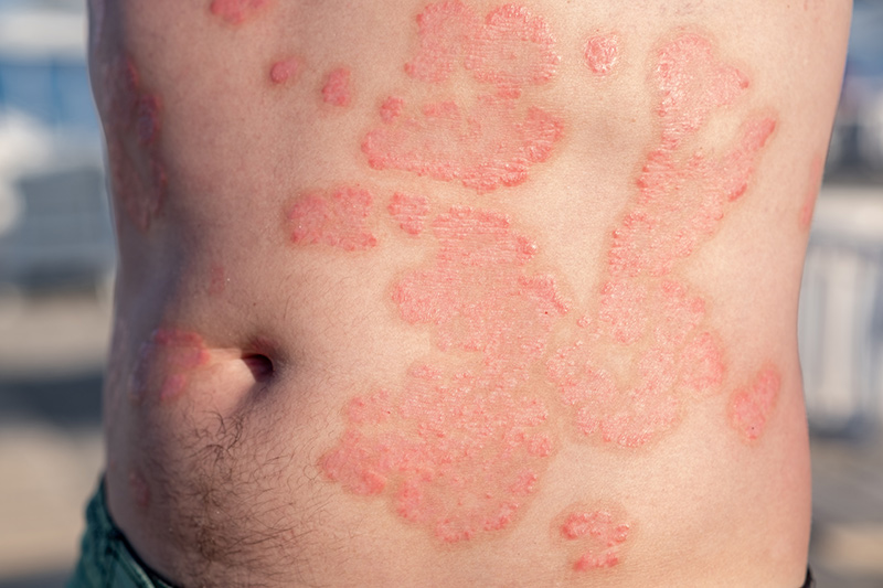 Eczema vs Psoriasis: What’s the Difference?