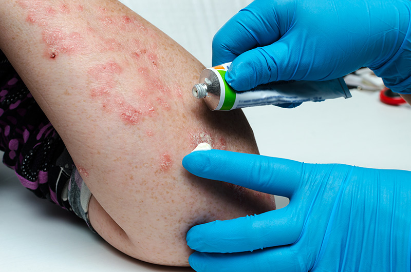 How Dermatologists Treat Moderate to Severe Eczema