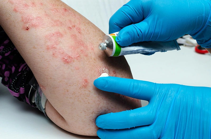 A dermatologist applying ointment to a patient’s eczema flare-up.