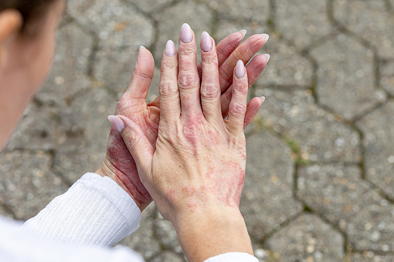 What Are the 7 Different Types of Eczema?