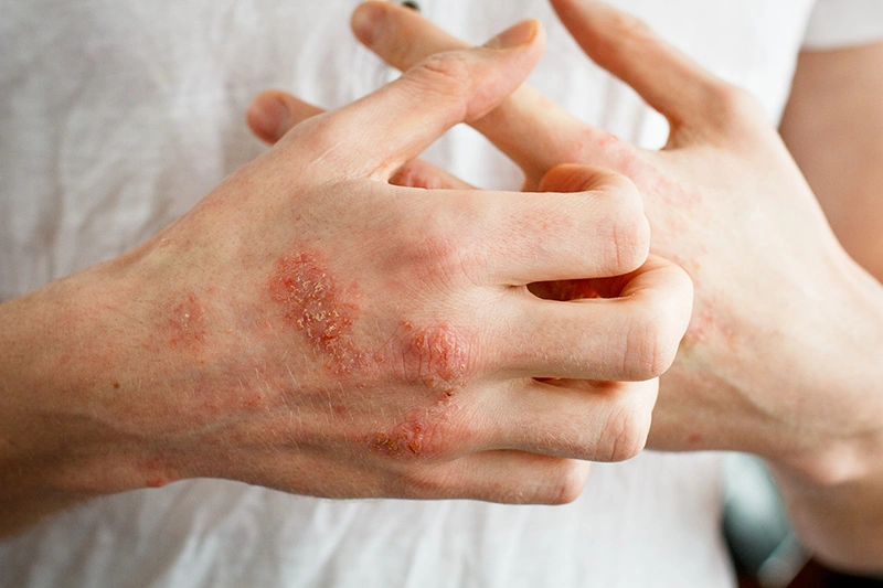 Patient experiencing an eczema flare-up